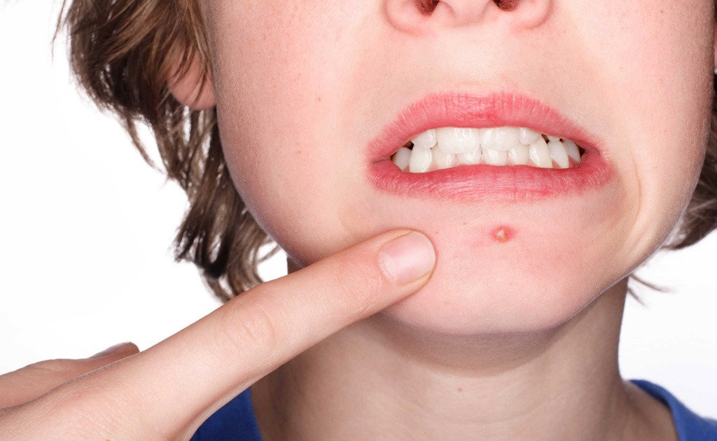 Da dễ nổi mụn vào mùa hè: Nguyên nhân và cách khắc phục