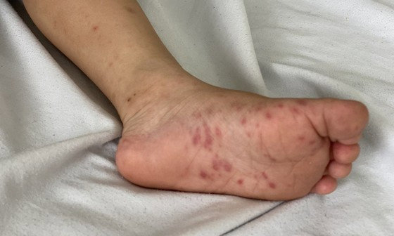 Gần 9.000 ca mắc tay chân miệng, 3 ca tử vong, Bộ Y tế chỉ đạo khẩn