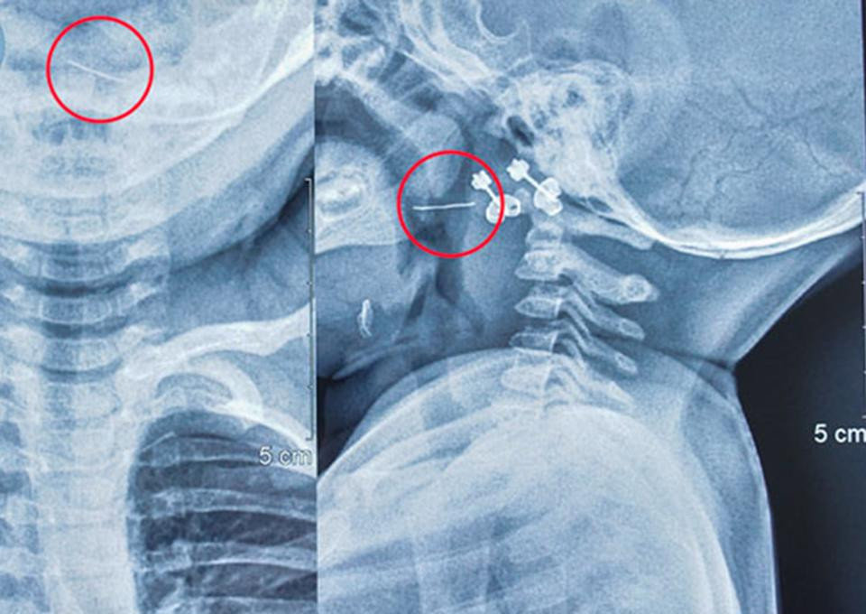 Sợi thép đâm xuyên qua amidan trái của bé 13 tháng tuổi