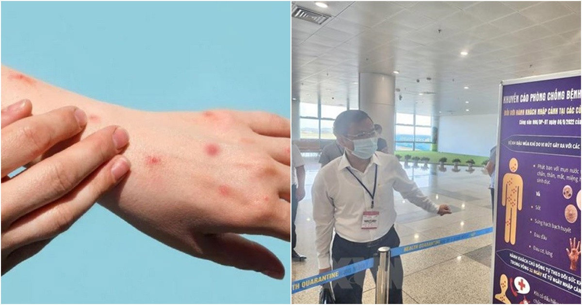 Việt Nam ghi nhận 56 trường hợp nhiễm đậu mùa khỉ, Bộ Y tế cảnh báo mầm bệnh đã xâm nhập trong cộng đồng